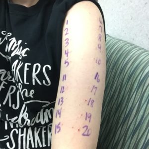 An image of my right upper arm where nurse injected allergens for my allergy testing, labeled with letters.