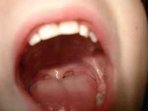 An image of a caucasian child's mouth, open wide with their teeth, tongue, and uvula visible. This is representative of the way one may open wide for a doctor to inspect the tonsils and throat.